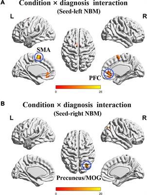 Effects of Cigarette Smoking on Resting-State Functional Connectivity of the Nucleus Basalis of Meynert in Mild Cognitive Impairment